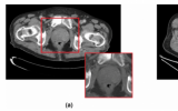 科学家将人工智能工具用于分析CT扫描 几秒钟内发现前列腺癌