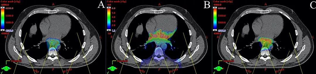 图2. 应用后斜野笔形束扫描质子治疗远端食管癌，5000 cGy/25f的蒙特卡罗剂量计算。(A)以cGy表示物理剂量，(B)以keV/mm表示线性能量转移(LET)， (C)包含物理剂量和LET的模拟生物剂量。注意，高LET区位于心脏靶区远端。