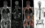 ISMRM: PET/MRI提高了临床癌症成像的价值